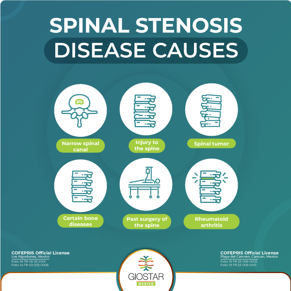 Causes of Spinal Stenosis Listing of causes of Spinal Stenosis