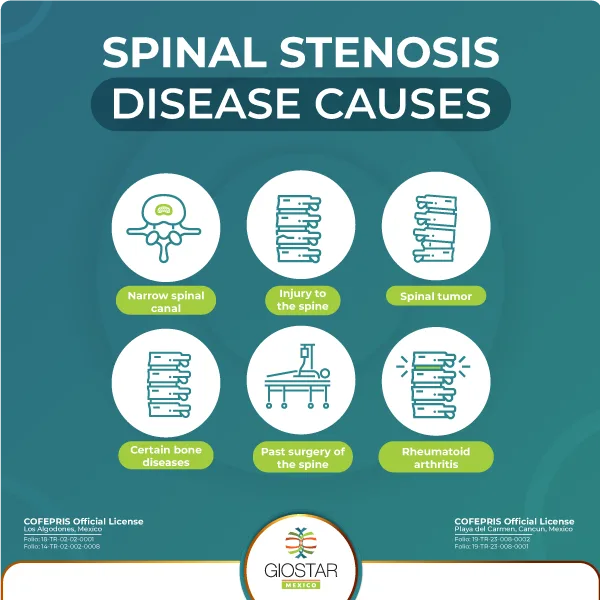 Listing of causes of Spinal Stenosis